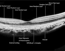 Image result for Macular OCT Images