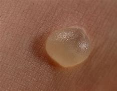 Image result for Silver Warts
