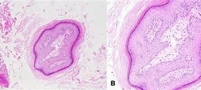 Image result for External Ear Papilloma