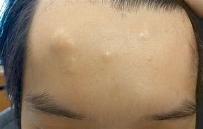 Image result for Epidermoid Cyst On Face
