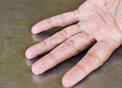 Image result for Scabies On Palm of Hand