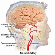 Image result for Carotid Artery Bifurcation