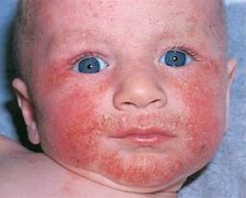 Image result for Types of Allergy