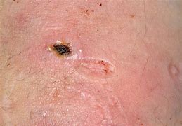 Image result for Cigarette Burn Marks On Skin