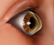 Image result for Keratoconus Contact Lenses Solution