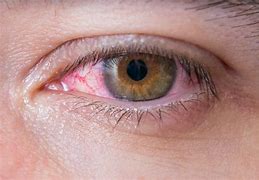 Image result for Irritant Eyes with Bowel Cancer