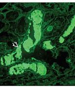 Image result for Myeloma Cast Nephropathy