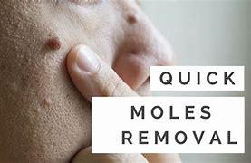 Image result for Mole Removal at Home