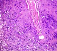 Image result for Verrucous Melanoma Histology