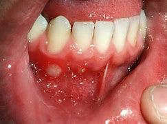 Image result for Anemia Mouth Ulcers