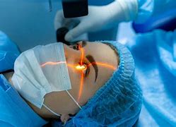 Image result for Laser Cataract Surgery