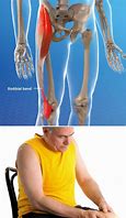 Image result for ITB Knee Pain Treatment