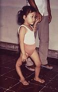 Image result for What Is Poliomyelitis