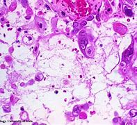 Image result for Herpes Simplex