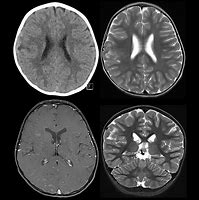 Image result for CT Scan of Oligodendroglioma