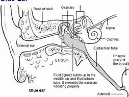 Image result for Ear Canal Wart