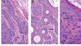 Image result for Infundibulocystic Basal Cell Carcinoma
