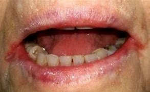 Image result for Iron Deficiency Rash around Mouth