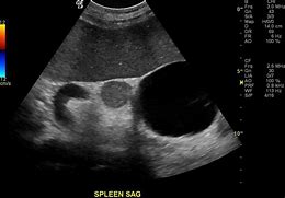 Image result for Accessory Spleen Ultrasound