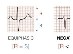 Image result for Horizontal Axis On ECG