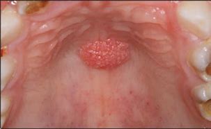 Image result for Papilloma Intraoral