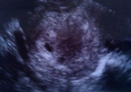 Image result for 5 Weeks 2 Days Pregnant