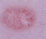 Image result for Molluscum Contagiosum Dermoscopy