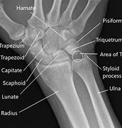 Image result for X-ray of Hand and Wrist