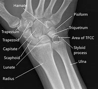 Image result for Accessory Bones Wrist