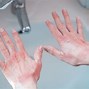 Image result for Soap Allergic Reaction