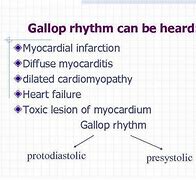 Image result for Myocardi Gallop Rhythm