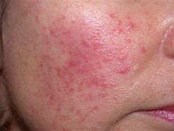 Image result for Red Sores On Face
