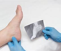 Image result for Bone Spur Treatment