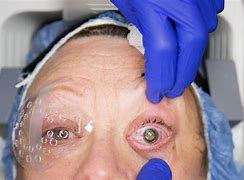 Image result for Eye Implant Surgery