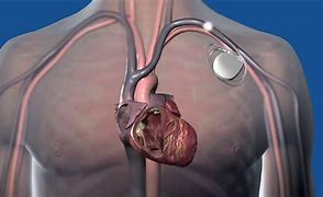 Image result for External Cardiac Defibrillator