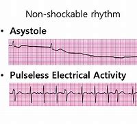 Image result for CPR Shockable Rhythms