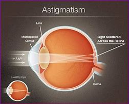 Image result for Contact Lens for Astigmatism Eo