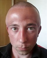 Image result for SunBurn Forehead