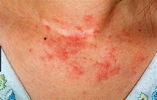 Image result for Itchy Skin Rash On Neck