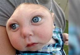 Image result for Baby Born without Skull