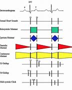 Image result for Gallop Rhythm Cardiology