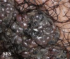 Image result for Genital Warts vs Mole