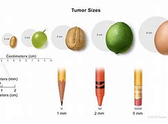 Image result for Cancer Tumor Size Chart