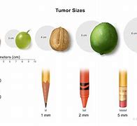 Image result for Tumor Size Chart