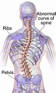 Image result for Scoliosis of Lumbar Spine