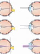 Image result for Undercorrection of Corneal Refractive Surgery