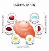 Image result for Ovarian Cyst Size Chart