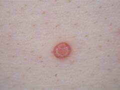 Image result for Molluscum Contagiosum Tattoo
