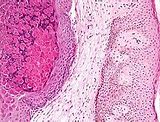 Image result for Molluscum Contagiosum HIV