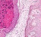 Image result for How Do You Treat Molluscum Contagiosum